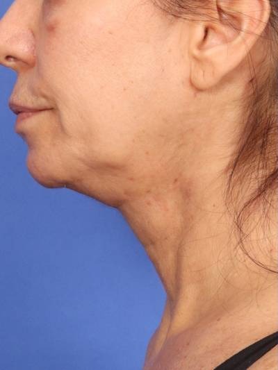 Skin Resurfacing Before & After Image