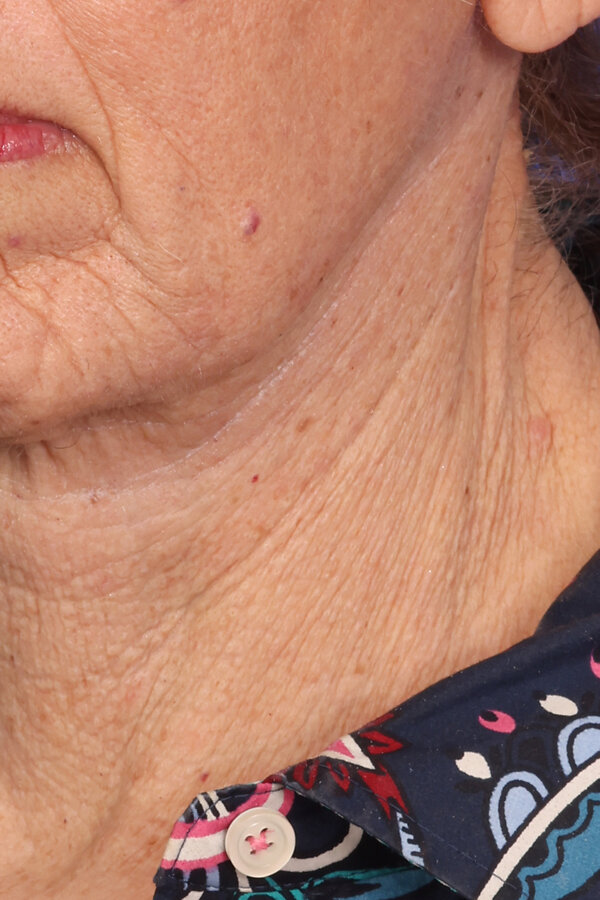 ZenTite Before & After Image