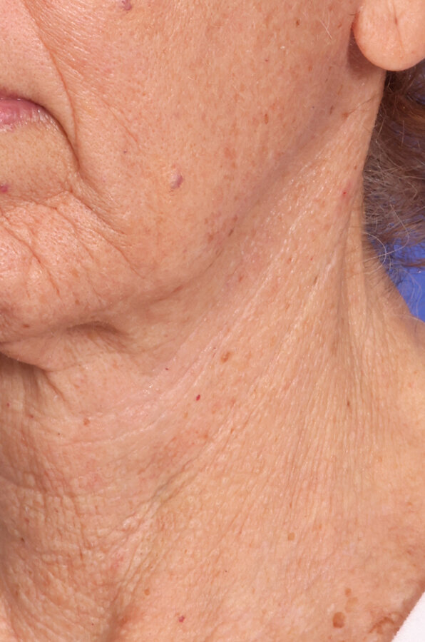 ZenTite Before & After Image