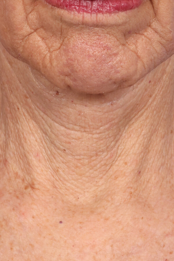 ZenTite Before & After Image