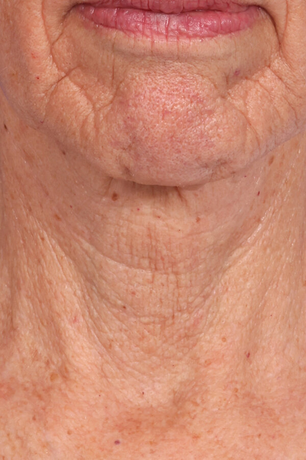 ZenTite Before & After Image