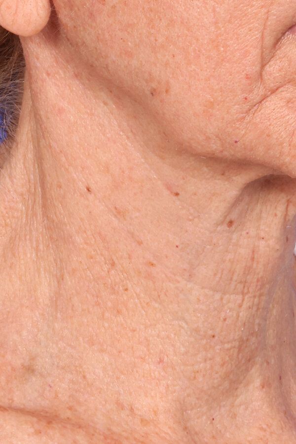 ZenTite Before & After Image