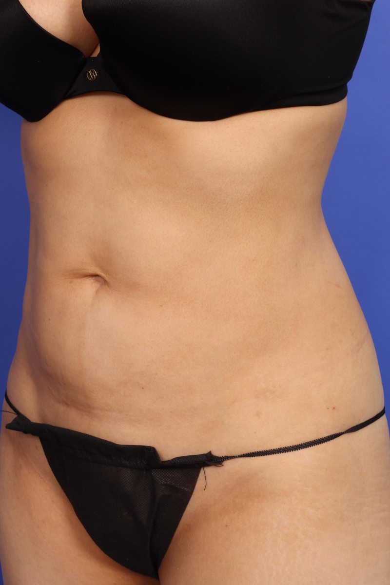 AYON Skin Tightening Before & After Image