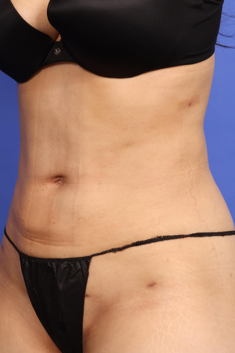 AYON Skin Tightening Before & After Image