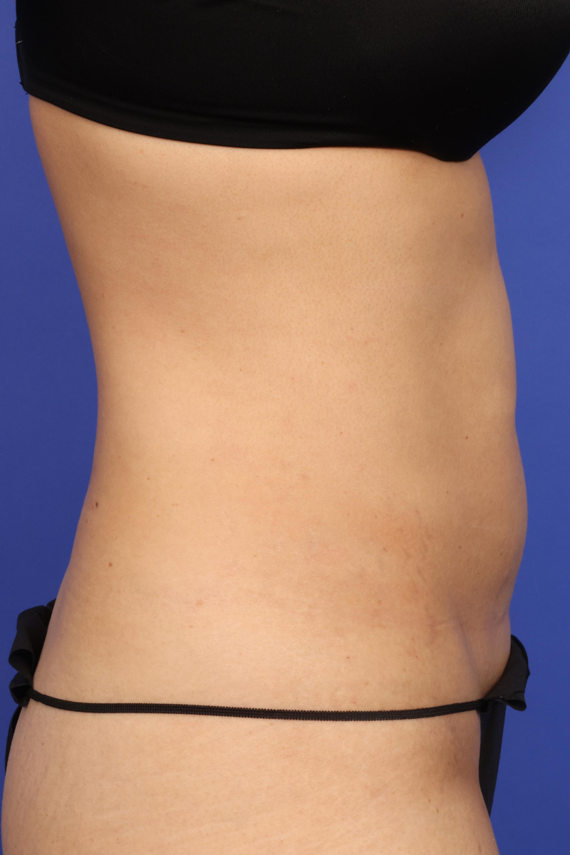 AYON Skin Tightening Before & After Image