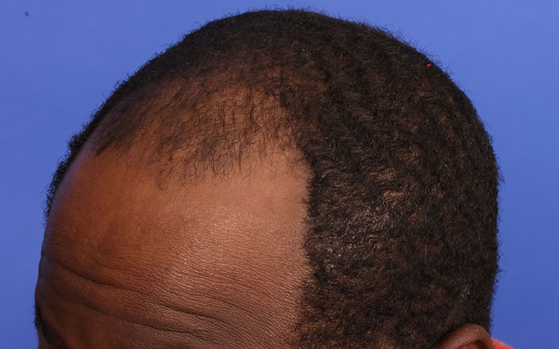 Hair Transplant Before & After Image