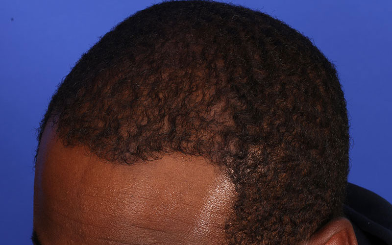 Hair Transplant Before & After Image