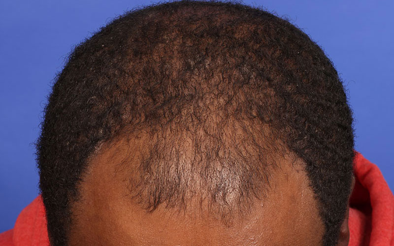 Hair Transplant Before & After Image