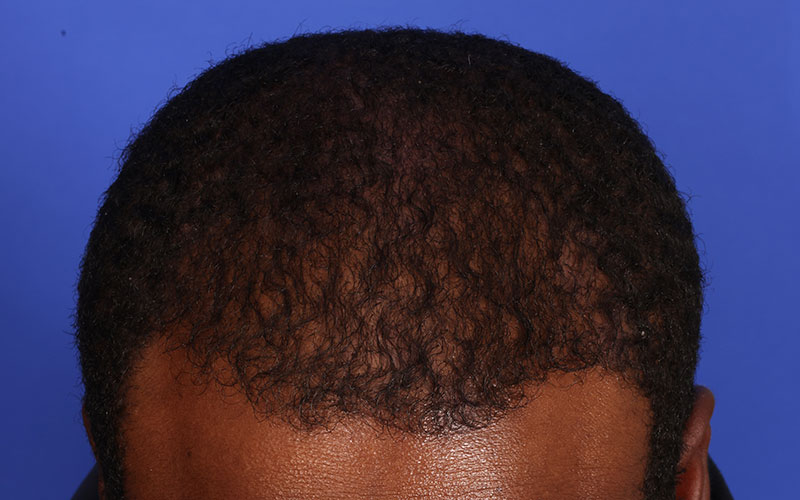 Hair Transplant Before & After Image