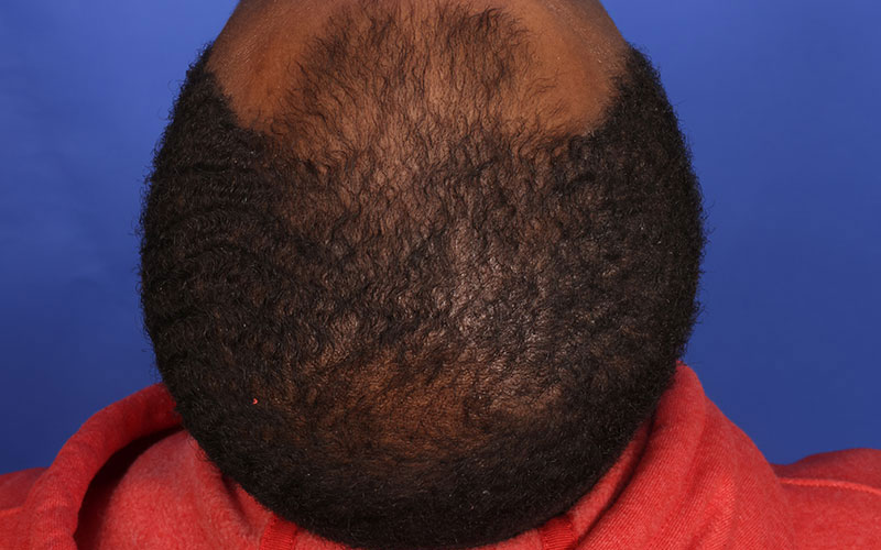 Hair Transplant Before & After Image