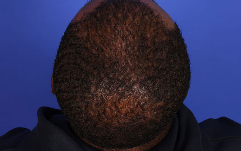 Hair Transplant Before & After Image