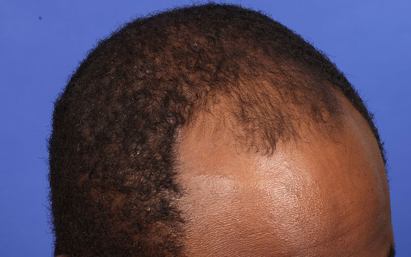 Hair Transplant Before & After Image