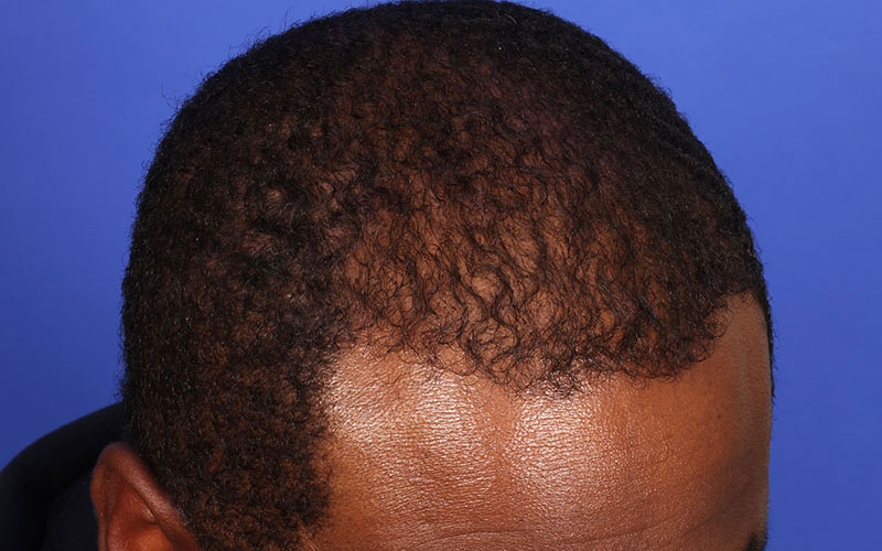 Hair Transplant Before & After Image