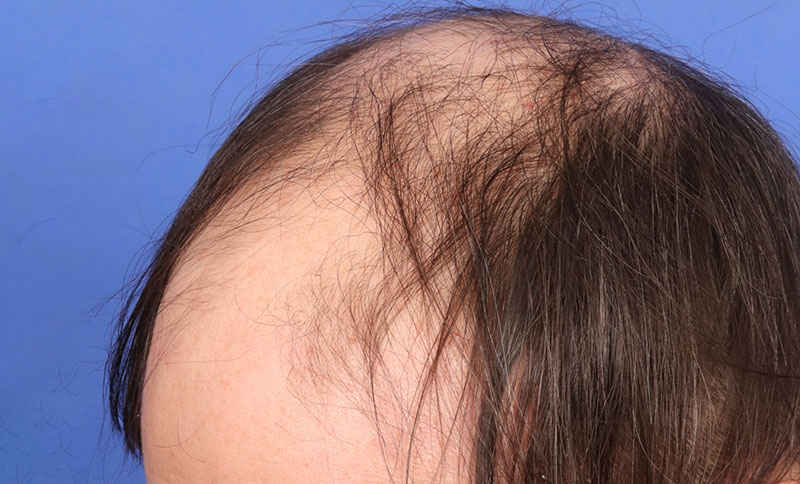 Hair Transplant Before & After Image