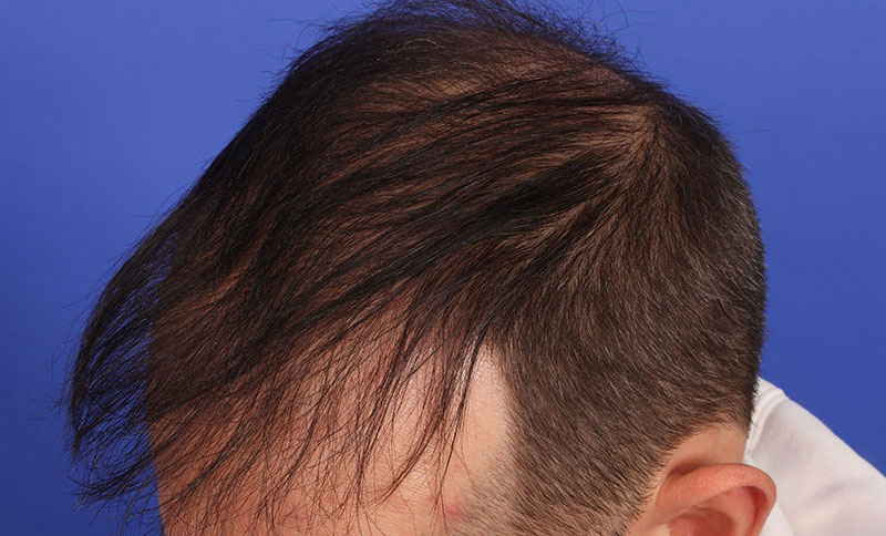 Hair Transplant Before & After Image