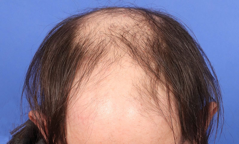 Hair Transplant Before & After Image