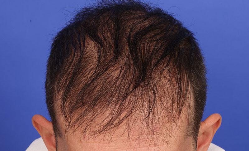 Hair Transplant Before & After Image