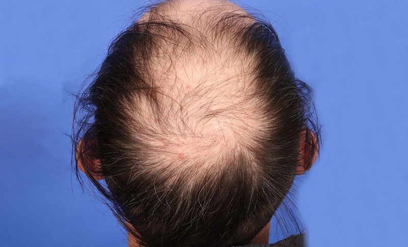 Hair Transplant Before & After Image