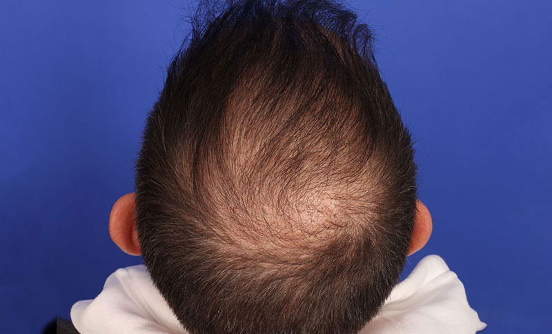 Hair Transplant Before & After Image