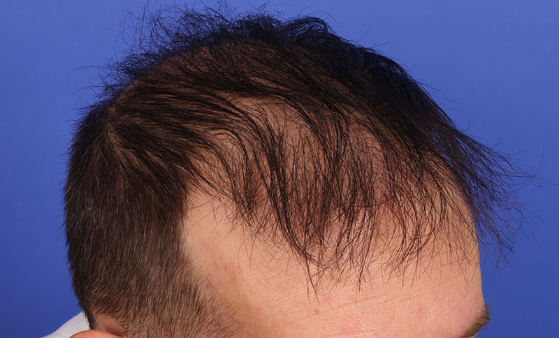 Hair Transplant Before & After Image