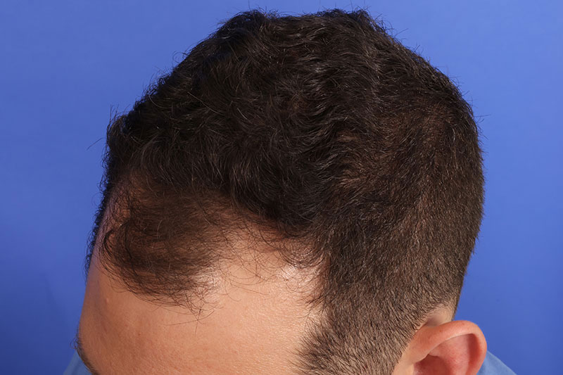 Hair Transplant Before & After Image