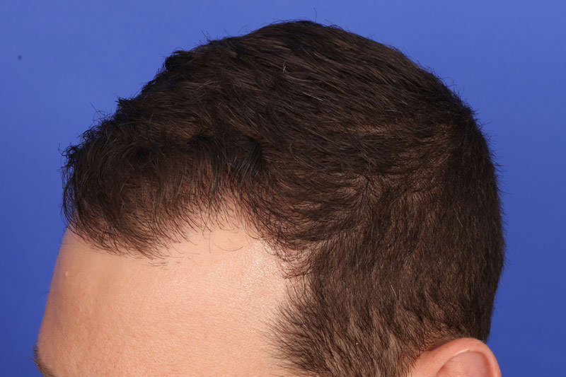 Hair Transplant Before & After Image