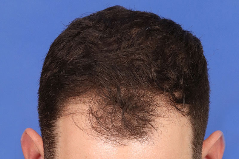 Hair Transplant Before & After Image