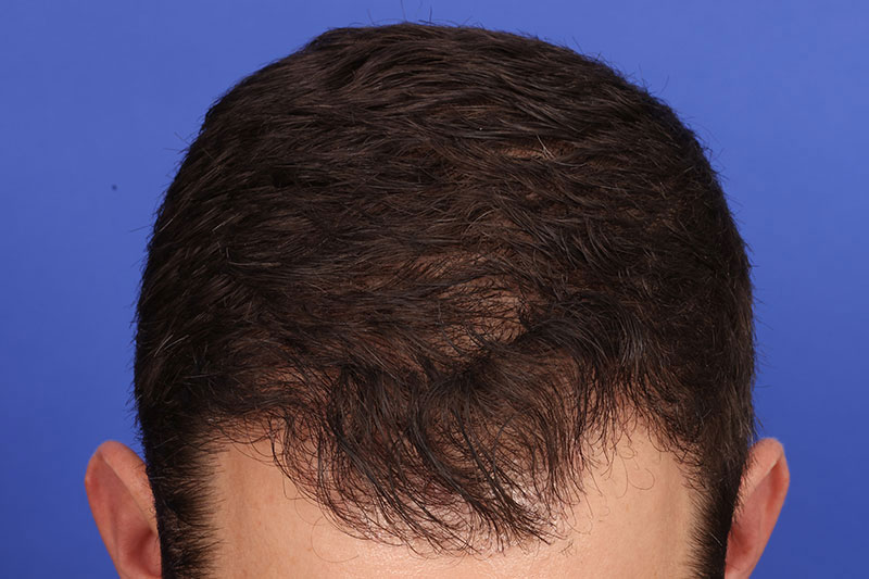 Hair Transplant Before & After Image