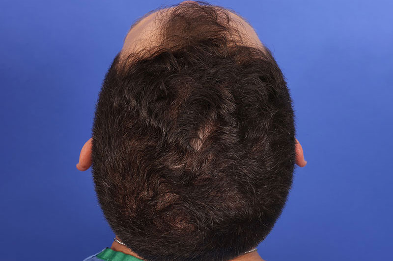 Hair Transplant Before & After Image