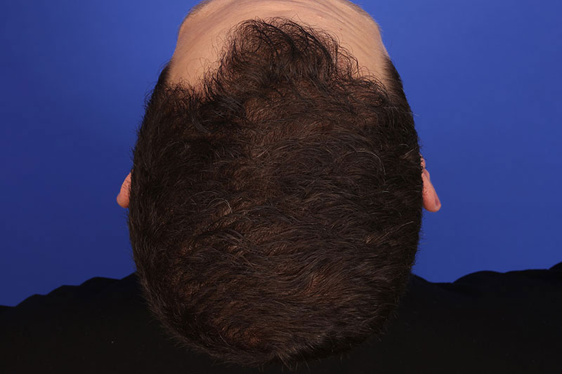 Hair Transplant Before & After Image