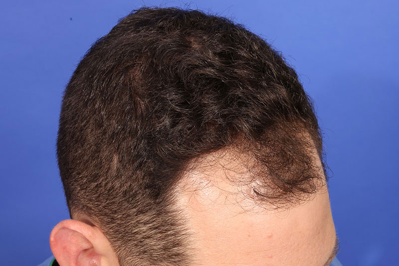 Hair Transplant Before & After Image