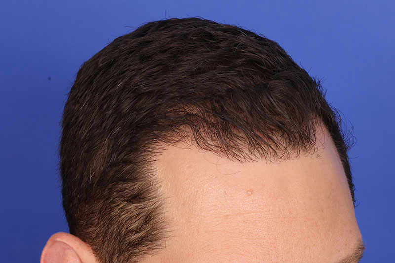 Hair Transplant Before & After Image