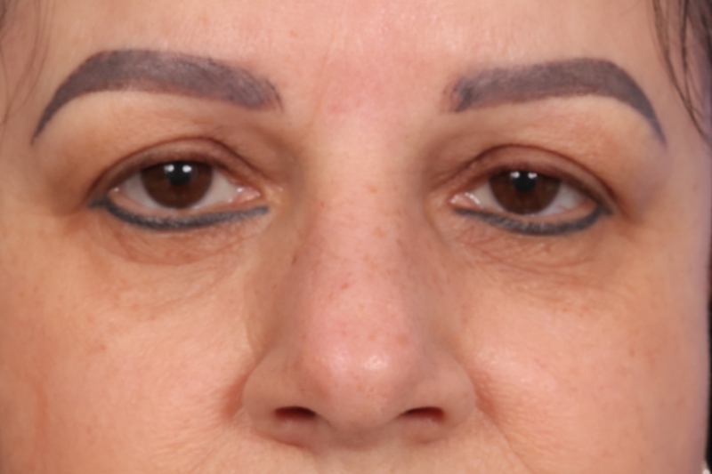 Hair Transplant Before & After Image