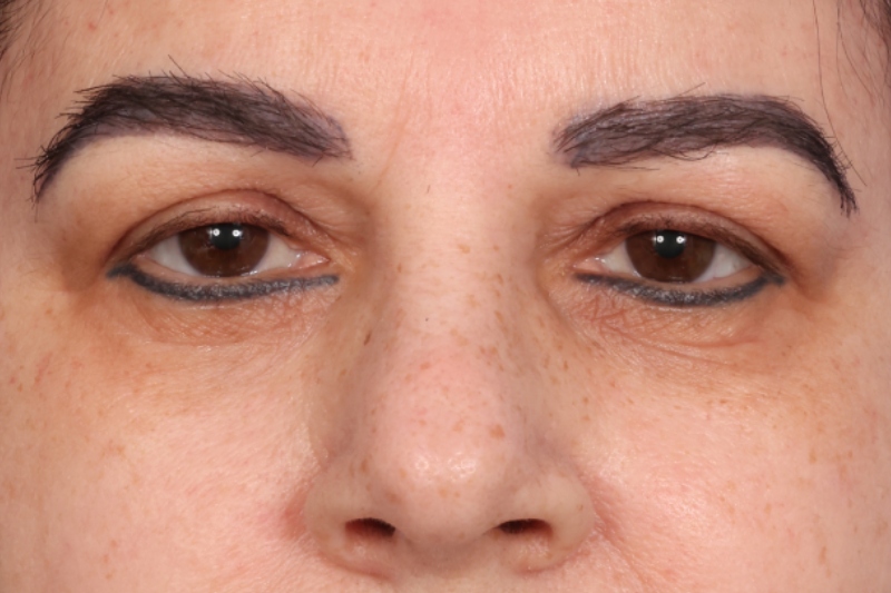 Hair Transplant Before & After Image