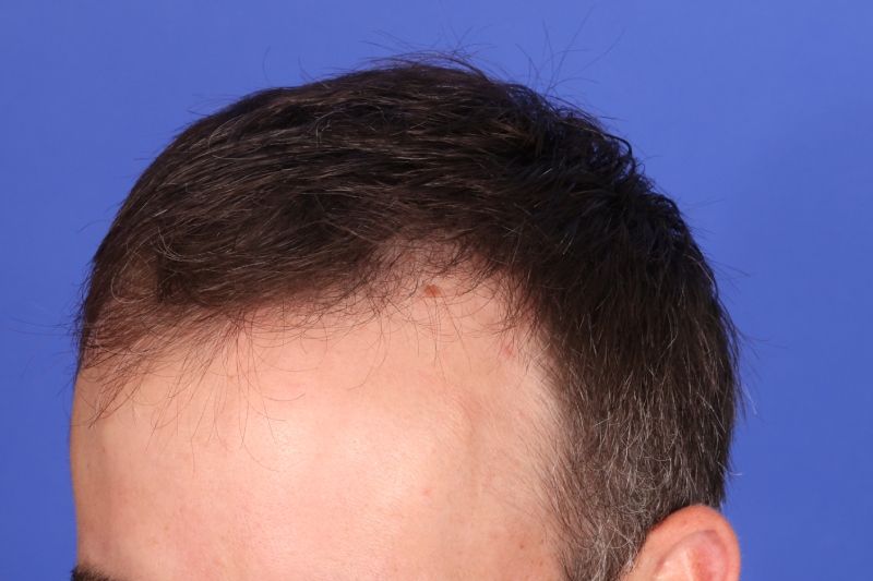 Hair Transplant Before & After Image