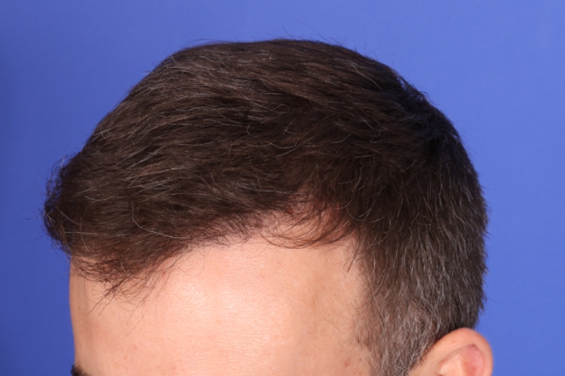 Hair Transplant Before & After Image