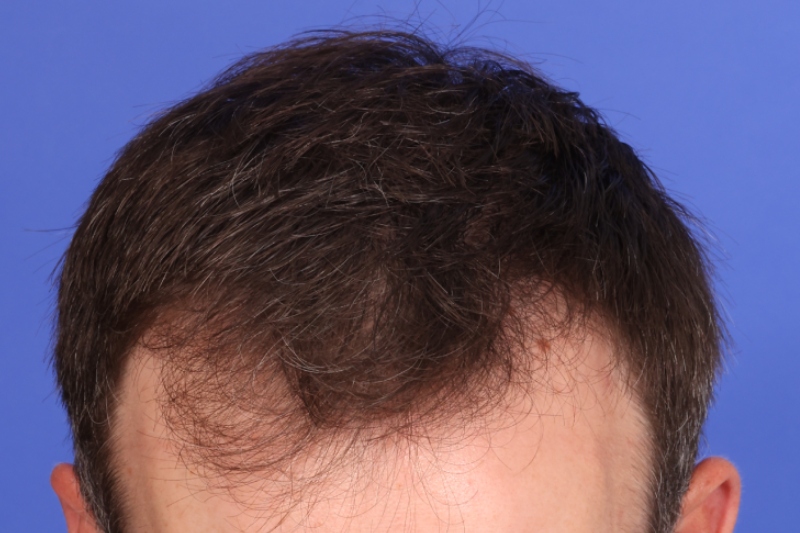 Hair Transplant Before & After Image