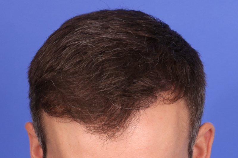 Hair Transplant Before & After Image