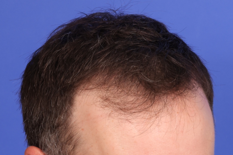 Hair Transplant Before & After Image