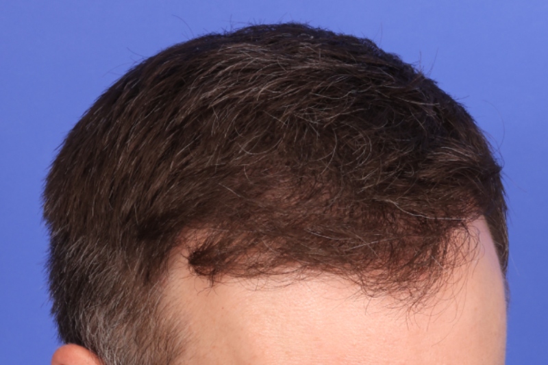 Hair Transplant Before & After Image
