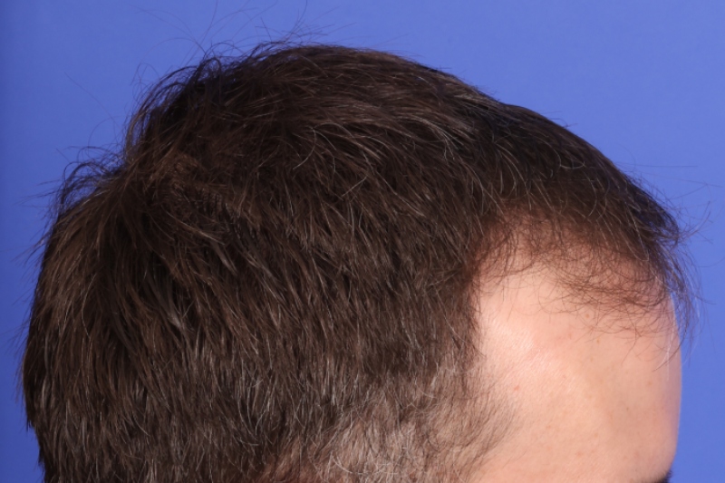 Hair Transplant Before & After Image