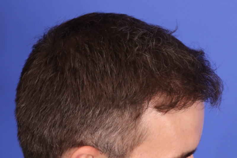 Hair Transplant Before & After Image