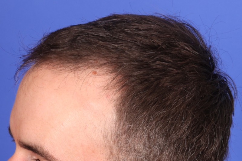 Hair Transplant Before & After Image