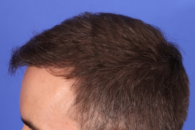Hair Transplant Before & After Image