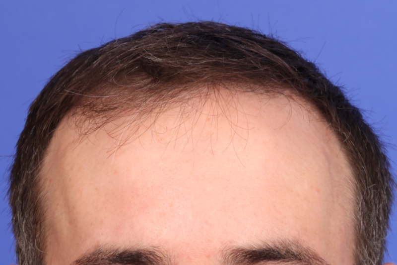 Hair Transplant Before & After Image