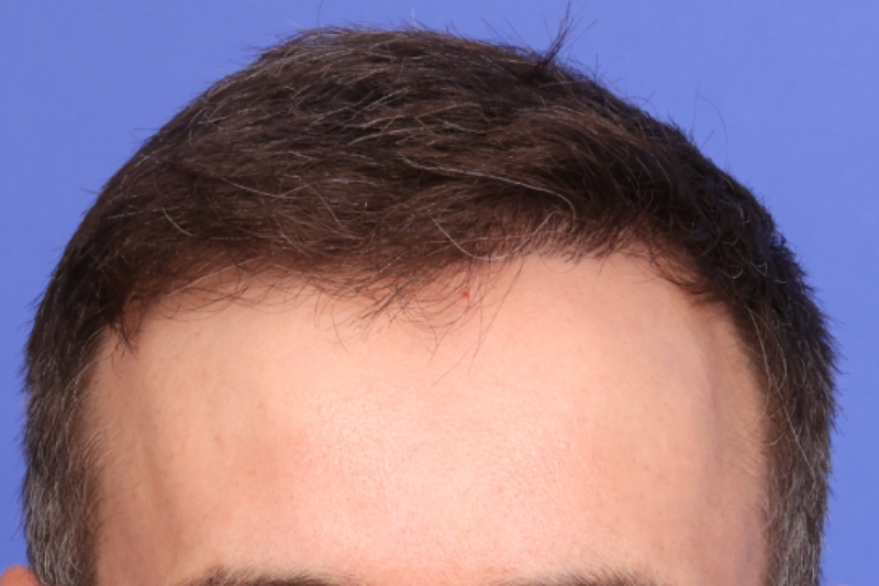 Hair Transplant Before & After Image