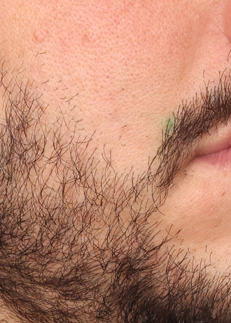 Hair Transplant Before & After Image