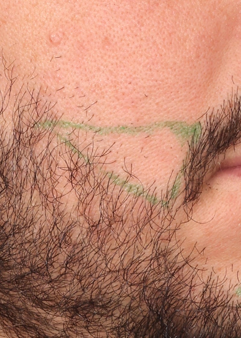 Hair Transplant Before & After Image