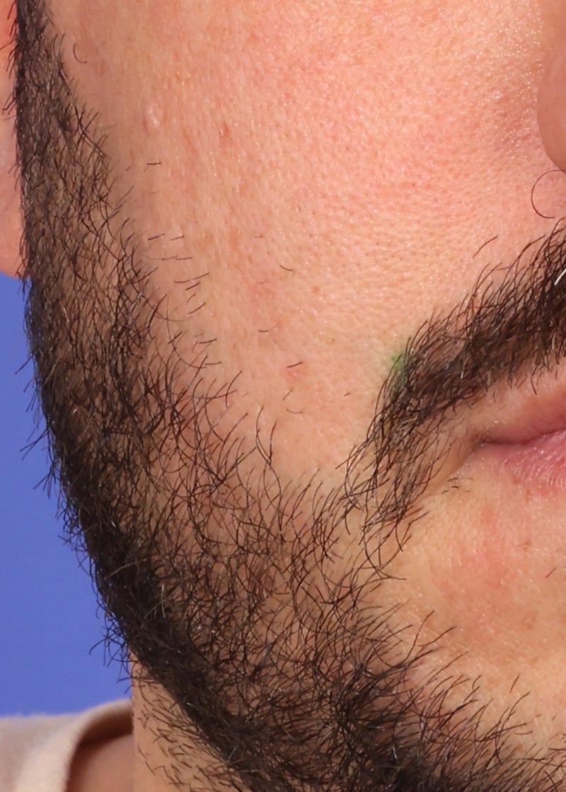 Hair Transplant Before & After Image