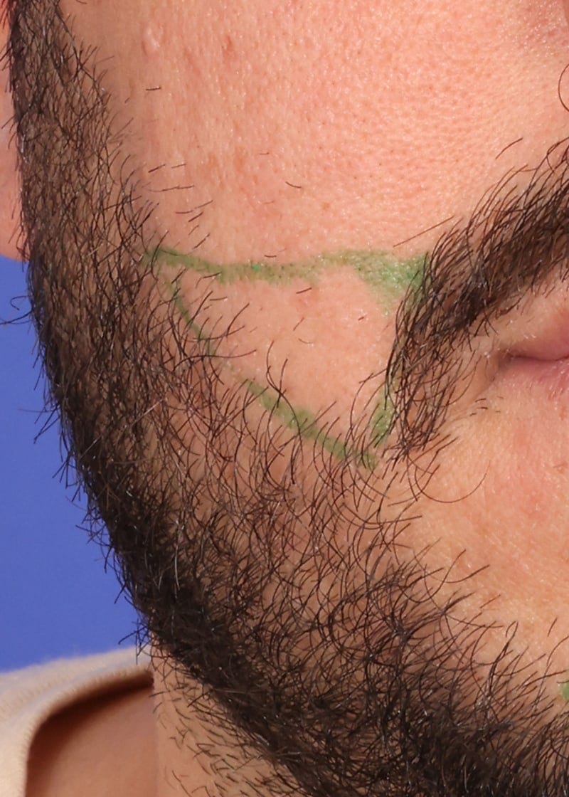 Hair Transplant Before & After Image